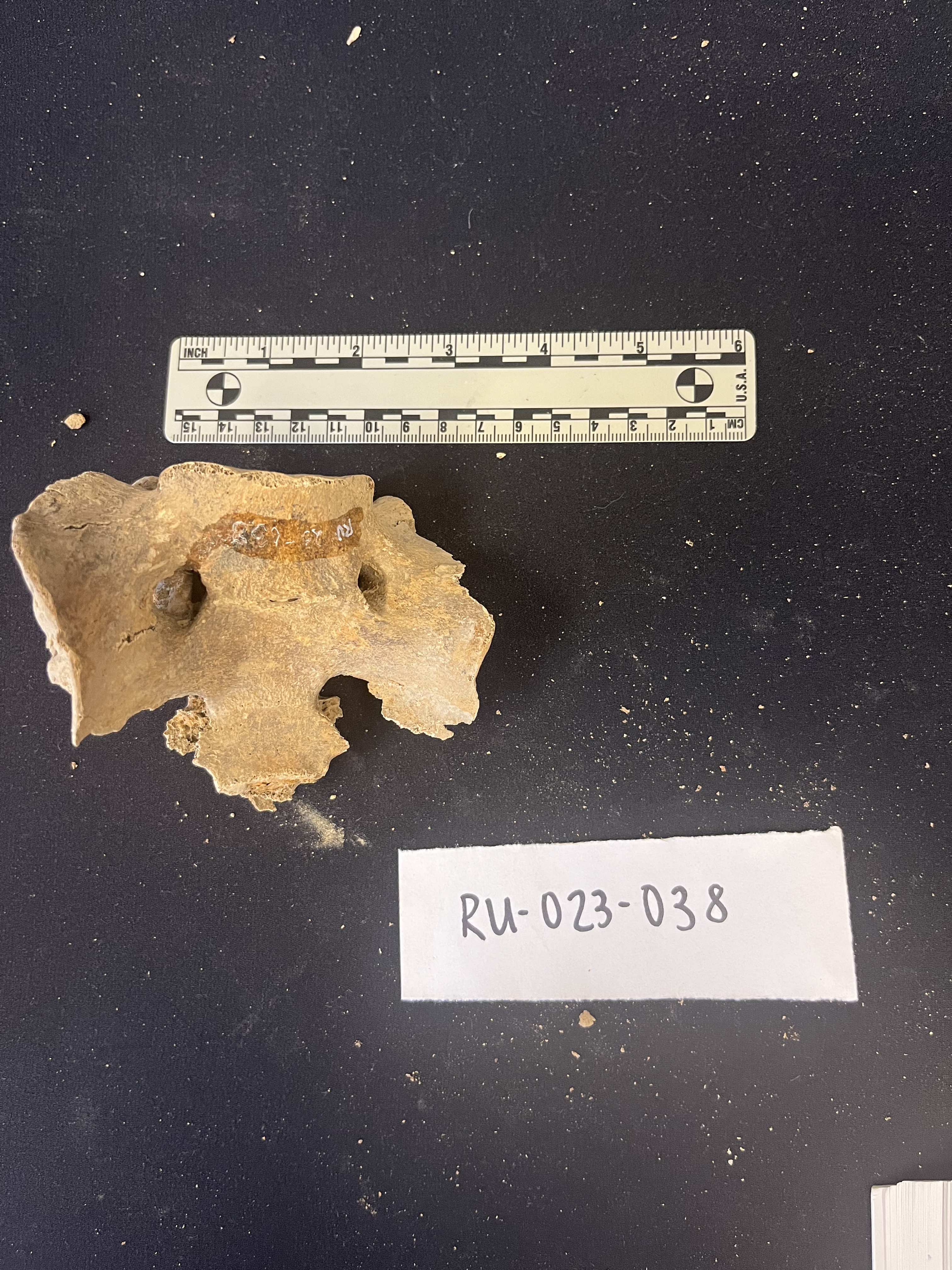 sacrum with L5 fusion