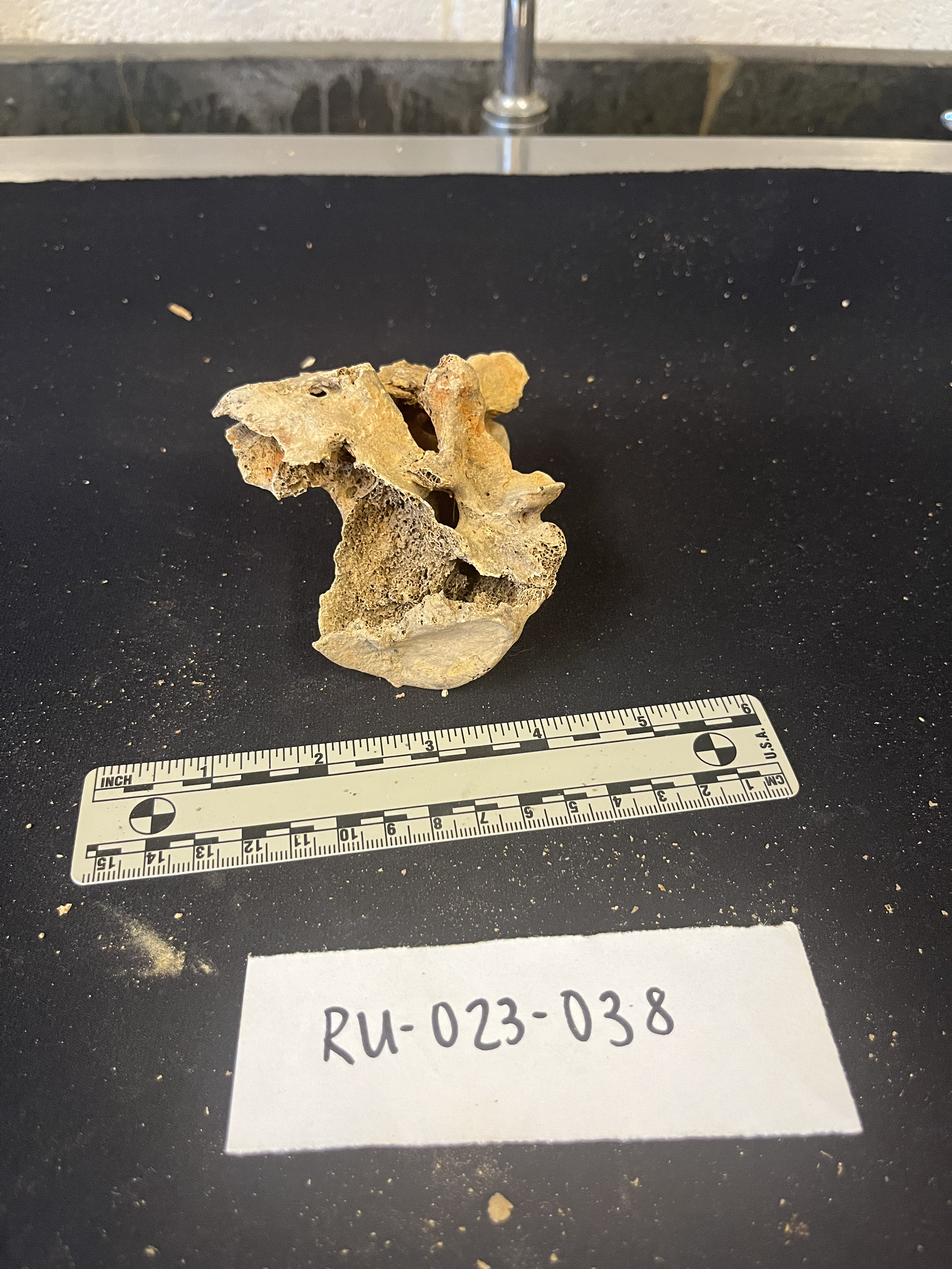 sacrum with L5 fusion