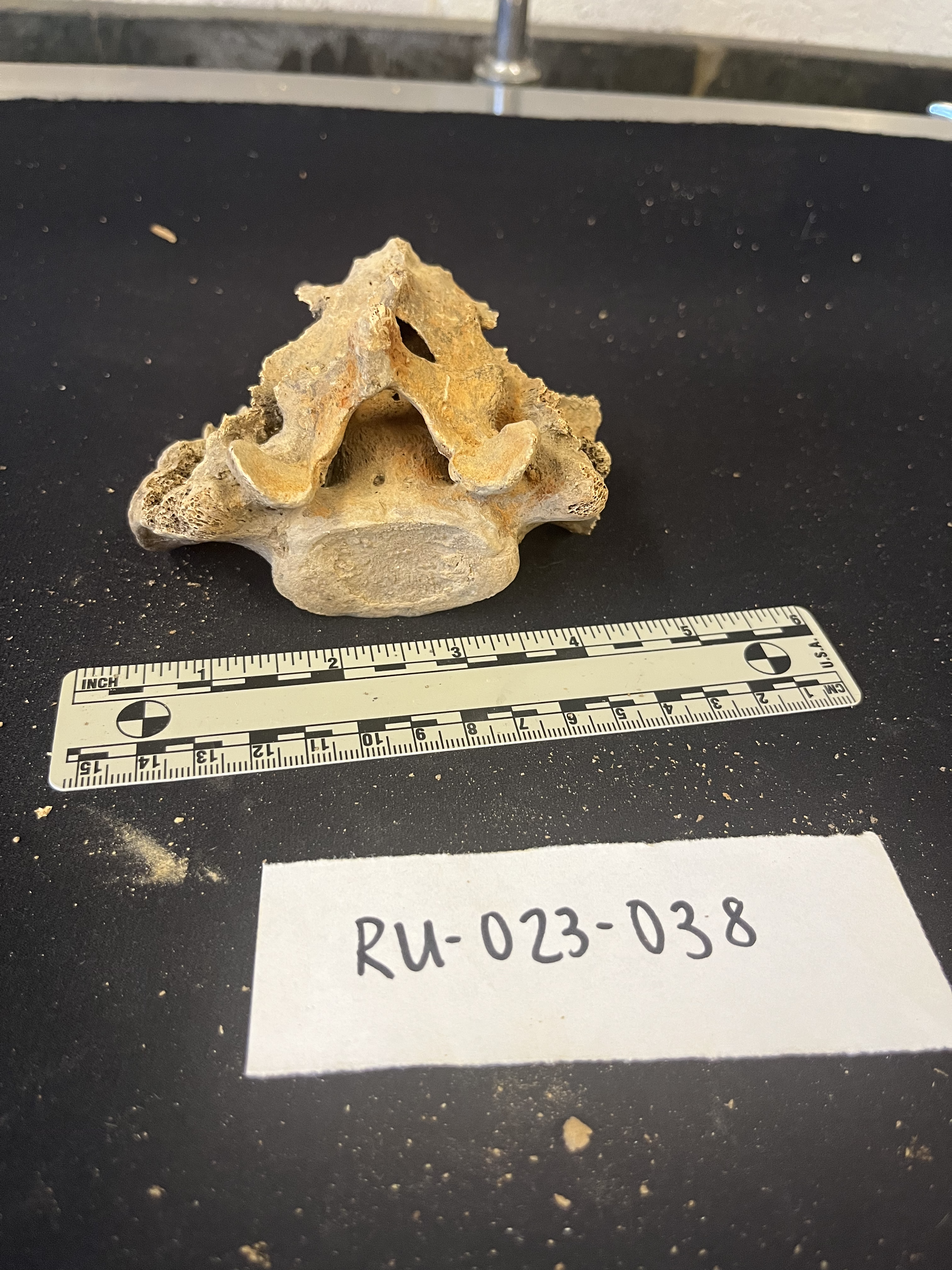 sacrum with L5 fusion